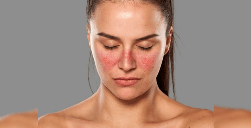 Is Stage 4 Lupus Deadly