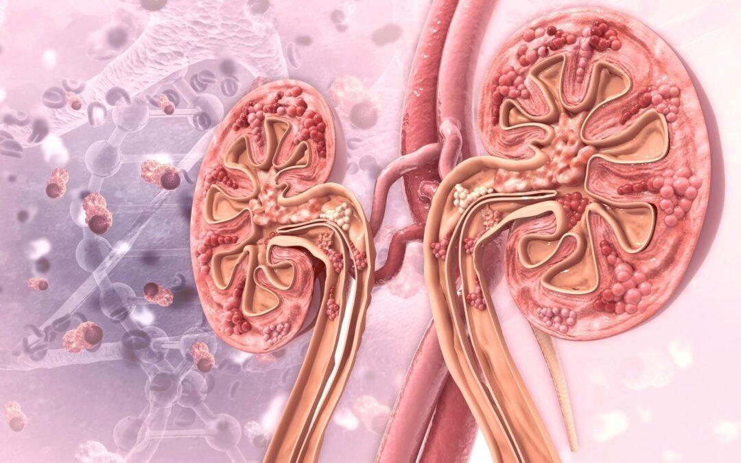 IgA Nephropathy