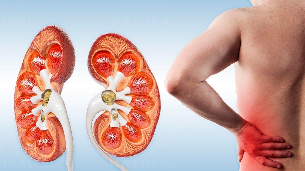 Treatment Options for Managing IgA Nephropathy