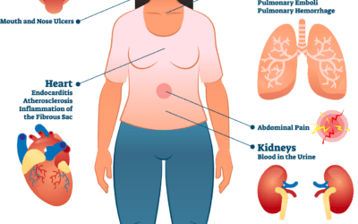 Stage 4 Lupus Symptoms And Causes