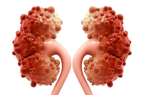 What happens to the body when you have polycystic kidney disease