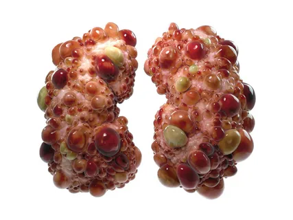 What happens to the body when you have polycystic kidney disease