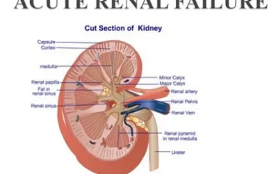 Phases of Acute Renal Failure