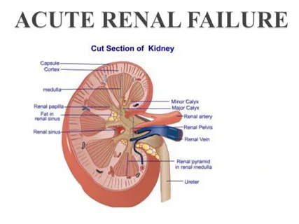 Phases of Acute Renal Failure