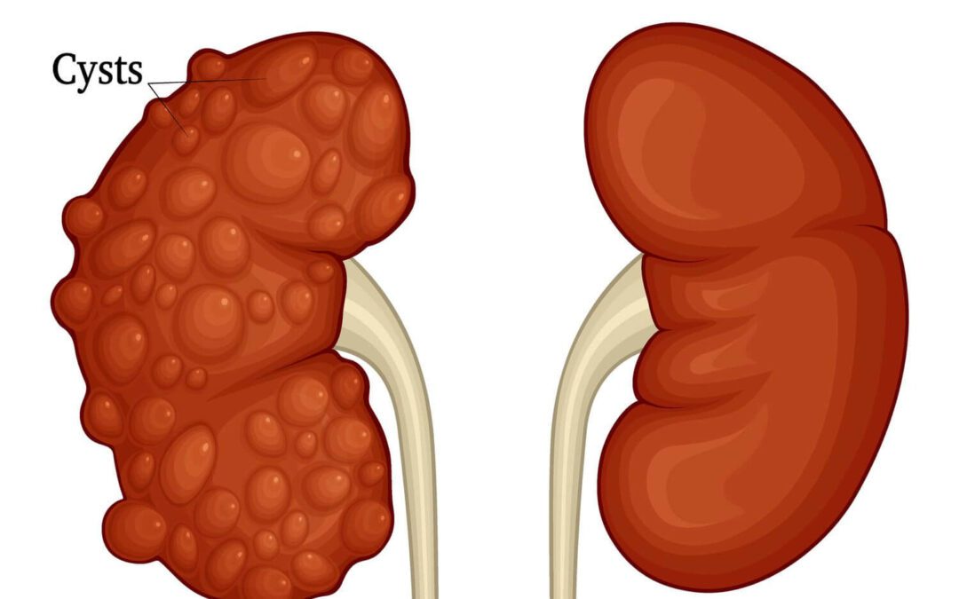 What is the difference between a normal kidney and a polycystic kidney?