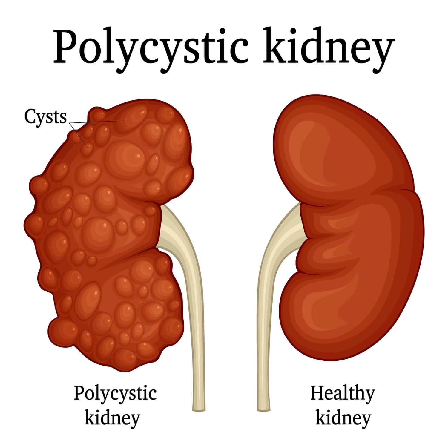 Differentiate b/w Normal Kidney vs Polycystic Kidney